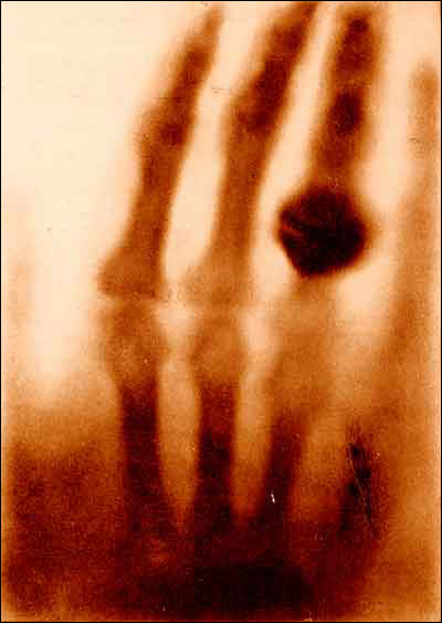 A blurry x-ray of four fingers, one of them with a large ring. From The hand of Mrs. Wilhelm Roentgen: the first X-ray image, 1895. In Otto Glasser, Wilhelm Conrad Röntgen and the early history of the Roentgen rays (London, 1933). 