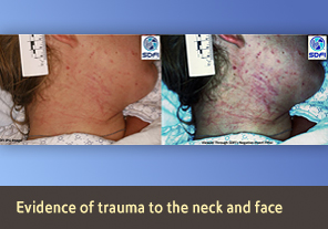 Side by side view of bruises on a White woman's neck,  showing normal view, and alternate view.