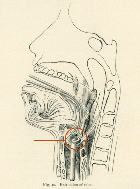 Cross section of mouth and neck anatomy, with an instrument reaching through the mouth to reach an intubation tube in the throat.