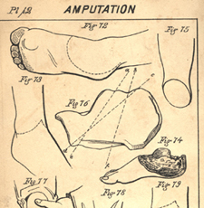 Black and white illustration of techniques for amputating hands and feet.