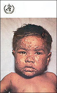 Front of Smallpox Recognition card featuring the head and shoulders full face view of a child with smallpox pustules.