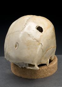 Skull showing blunt force hammer trauma, 1950s
