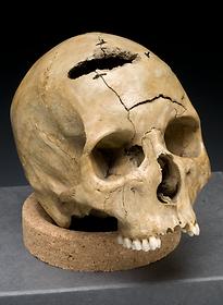 Skull showing keyhole gunshot trauma, about 1861-1865