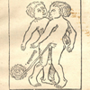 Fifteenth century woodcut illustration of female twins joined at the chest.