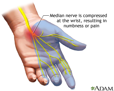 carpal tunnel syndrome 1081.jpg