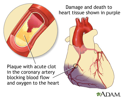 heart attack pictures. A heart attack or acute