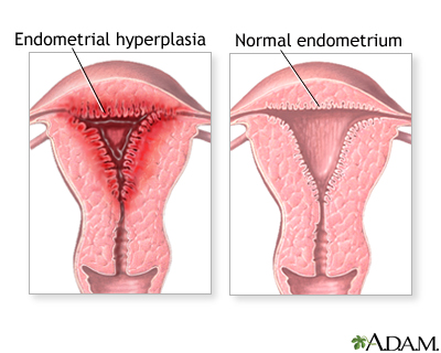 such as endometrial hyperplasia, endometrial polyps, uterine fibroids, 