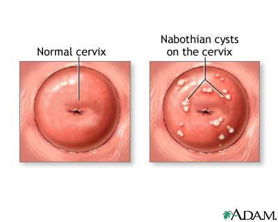 Uterine Fibroids-Cysts, Polyps, Nabothian.