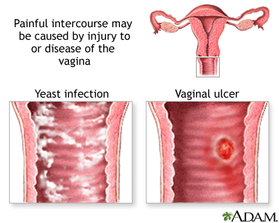 pain Deep during intercourse vaginal