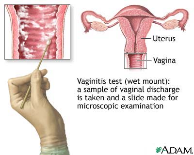 vaginitis photos
