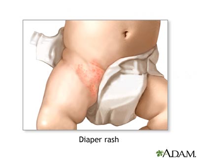 mupirocin for diaper rash