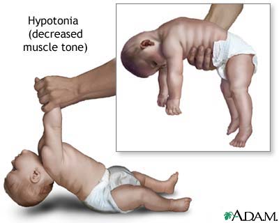 Hypotonic infants rest with their elbows and knees loosely extended, 
