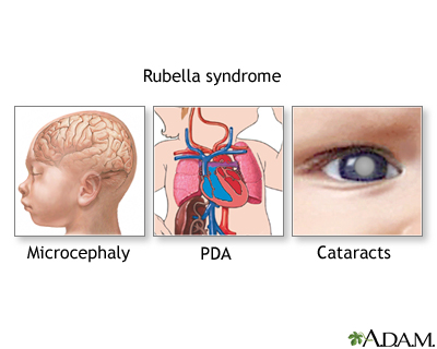 Rubella syndrome, or congenital rubella, is a group of physical 