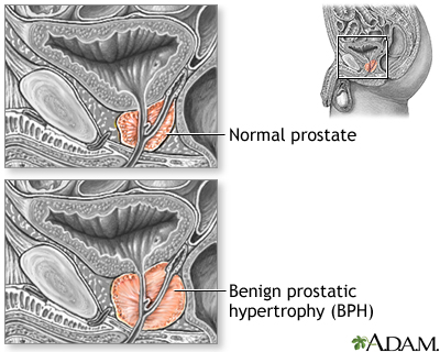 Benign prostatic hypertrophy 