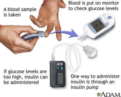 Glucose test: MedlinePlus