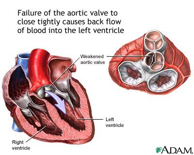 living with an aortic graft