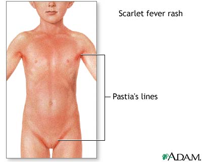  scarlet-colored rash from which this illness gets its name.