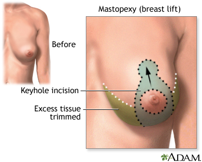 Mammograms (breast X-rays) and a routine breast exam are required before 