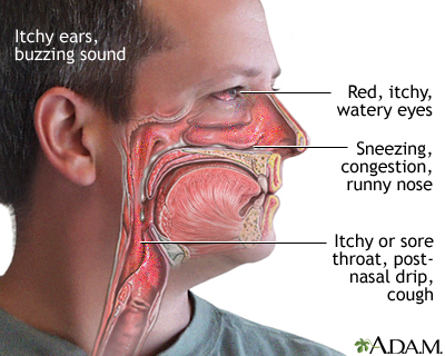 Allergies Symptoms Sore Throat in Australia