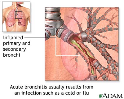 Cause of Acute Bronchitis