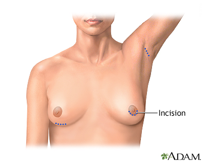 breast augmentation pictures. Breast augmentation - series: