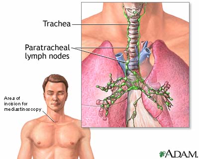 nodes in neck. through a neck incision to