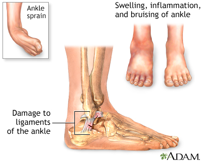 ankle sprain support