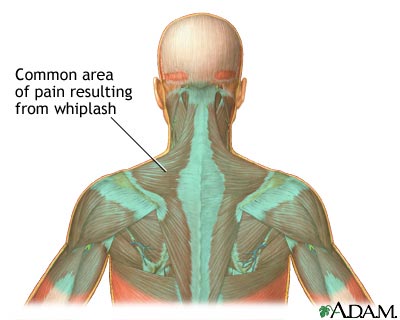 Whiplash injury strains the muscles and ligaments of the neck beyond 