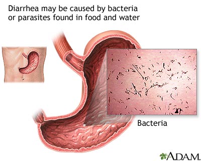 Diarrhea: causes, symptoms and treatments – medical 