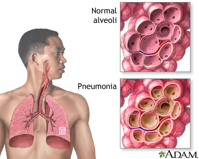 Inhaled corticosteroids for bronchitis