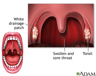 Can strep throat cause ear infections? |.