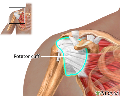 Rotator cuff repair - series: MedlinePlus Medical Encyclopedia