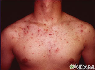 Bad back acne from steroids