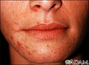 Hives and Angioedema Causes and Treatment - eMedicineHealth