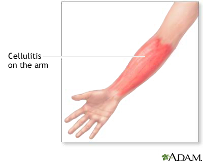 Cellulitis on the arm: MedlinePlus Medical Encyclopedia Image
