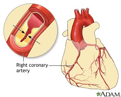 heart disease. Coronary artery disease