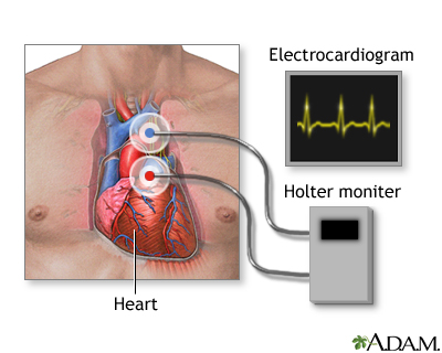 holter monitor re-creation