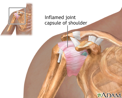 shoulder inflammation