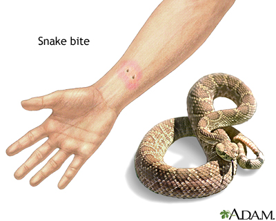 snake bite at hand