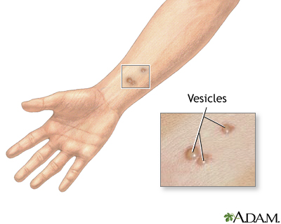 Vesicles: MedlinePlus Medical Encyclopedia