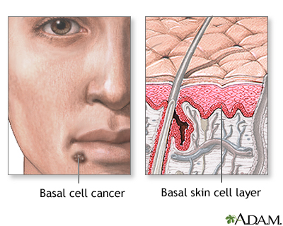 diagnosis  basal cell carcinoma