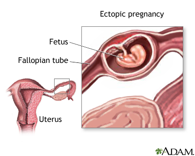Ectopic Pregnancy on Ectopic Pregnancy  Sites   Diagram  Drawing