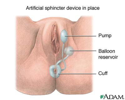 Artificial Anal Sphincter 100