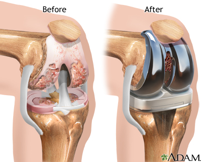 Metal allergies may affect joint replacement success