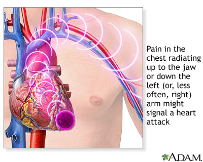 Symptoms of a possible heart attack include chest pain and pain that 