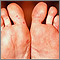 Hand, foot, and mouth disease is cause by a coxsackie virus. It produces mouth ulcers and small blisters (vesicles) on the hands and feet. The vesicles often have a reddish border with a white or lighter colored area in the center. 