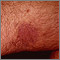 Kaposi's sarcoma on the thigh