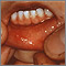 Hand, foot and mouth disease is a common childhood illness. The symptoms include small, painful blisters on the fingers, palms, toes and soles; and ulcers in the mouth. This photograph shows the small whitish to yellowish mouth ulcers with surrounding redness. 