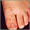Hand, foot and mouth disease is a common childhood illness. The symptoms include small, painful blisters on the fingers, palms, toes and soles; and ulcers in the mouth. This photograph shows the small blisters (vesicles) on the feet. 