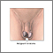ovarian teratoma histology stain